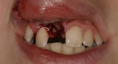 ¿Cuál es el sueño de un diente caído: delgado o bueno?