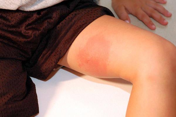 Alergia a la picadura de un mosquito en un niño. Primeros auxilios y protección