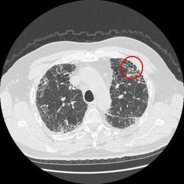 Hemosiderosis del pulmón: manifestación y tratamiento