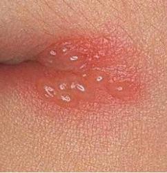 ¿Cómo curar rápidamente el herpes en los labios con medicamentos de quimioterapia y remedios caseros?