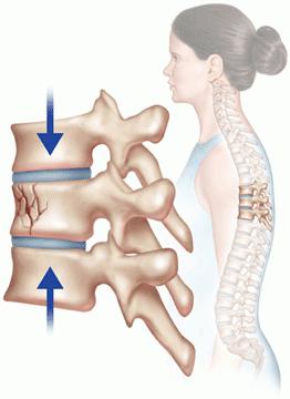 Causas, síntomas y tratamiento de la fractura por compresión de la columna vertebral